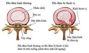 hình ảnh thoát vị đĩa đệm