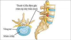 Thoát vị đĩa đệm