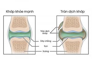 Thoái hóa khớp dễ dẫn tới tràn dịch khớp gối