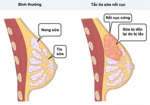 nguyên nhân tắc tia sữa