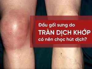 Tràn dịch khớp gối