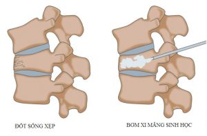 Điều trị xẹp đốt sống