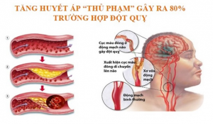 tăng huyết áp - thủ phạm hàng đầu dẫn đến đột quỵ