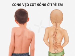 Cong vẹo cột sống ở trẻ em