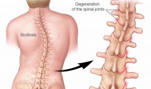 Cong vẹo cột sống ở người trưởng thành