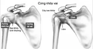 Đông cứng khớp vai