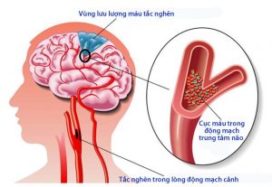 Tai biến mạch máu (trúng phong)